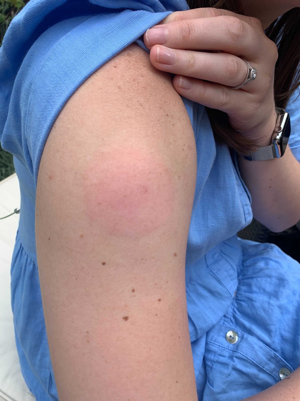arm swelling vaccine